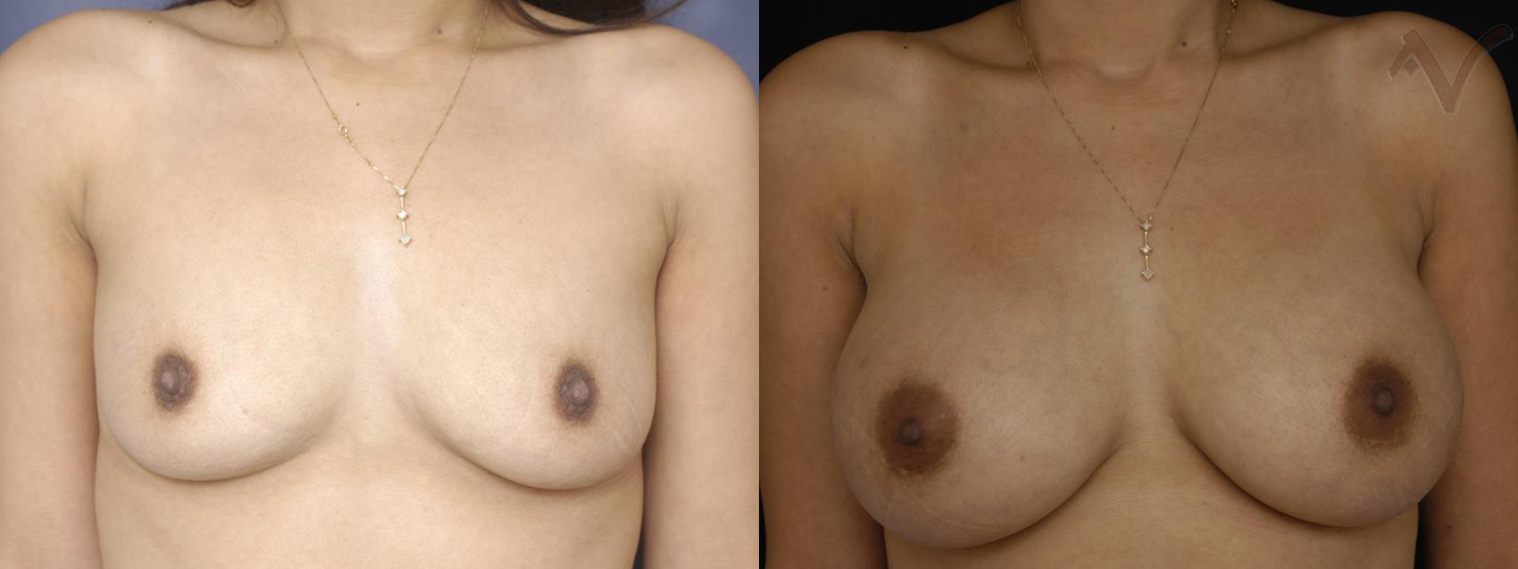 Before & After Breast Augmentation Case 139 Front View in Los Angeles, CA