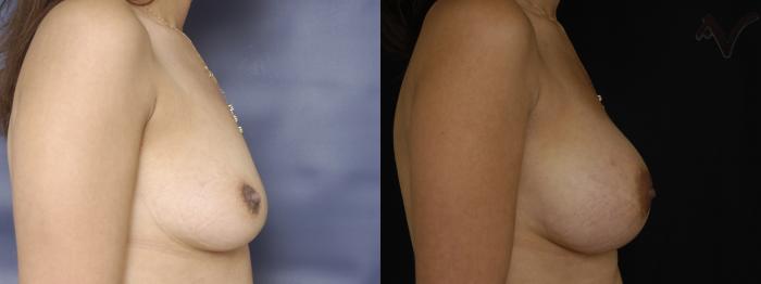 Before & After Breast Augmentation Case 139 Right Side View in Los Angeles, CA