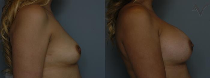 Before & After Breast Augmentation Case 140 Right Side View in Los Angeles, CA