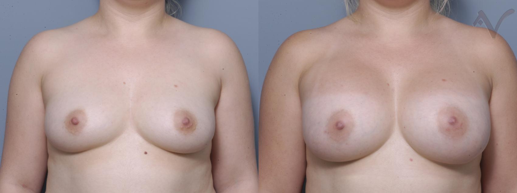 Before & After Breast Augmentation Case 141 Front View in Los Angeles, CA