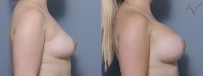 Before & After Breast Augmentation Case 141 Right Side View in Los Angeles, CA