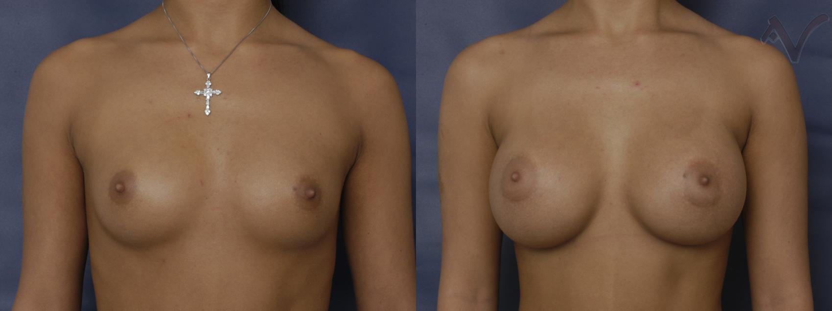 Before & After Breast Augmentation Case 143 Front View in Los Angeles, CA