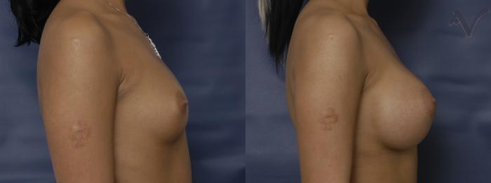 Before & After Breast Augmentation Case 143 Right Side View in Los Angeles, CA