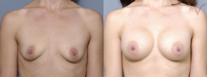 Before & After Breast Augmentation Case 145 Front View in Los Angeles, CA