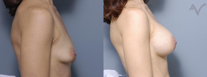 Before & After Breast Augmentation Case 145 Right Side View in Los Angeles, CA