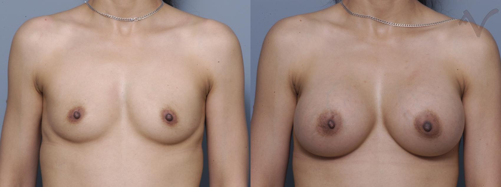 Before & After Breast Augmentation Case 147 Front View in Los Angeles, CA