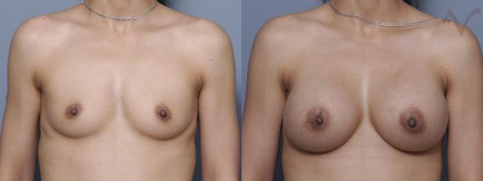 Before & After Breast Augmentation Case 147 Front View in Los Angeles, CA