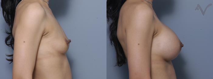 Before & After Breast Augmentation Case 147 Right Side View in Los Angeles, CA