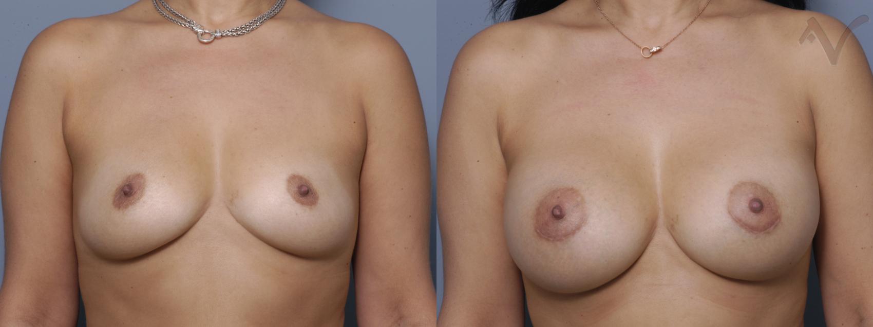 Before & After Breast Augmentation Case 148 Front View in Los Angeles, CA