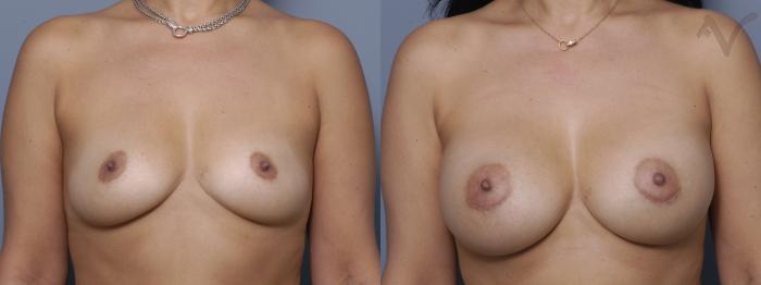 Before & After Breast Augmentation Case 148 Front View in Los Angeles, CA