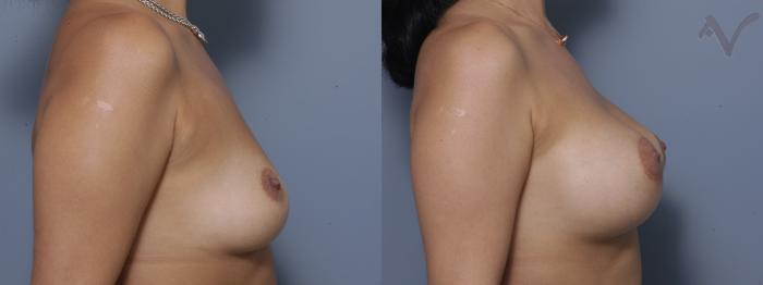 Before & After Breast Augmentation Case 148 Right Side View in Los Angeles, CA