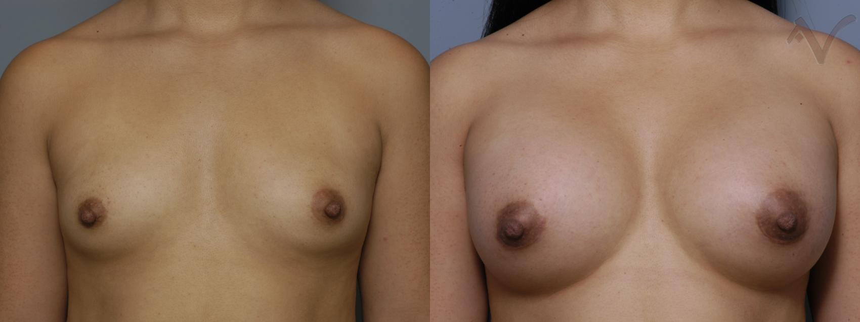 Before & After Breast Augmentation Case 152 Front View in Los Angeles, CA