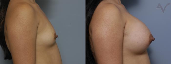 Before & After Breast Augmentation Case 152 Right Side View in Los Angeles, CA