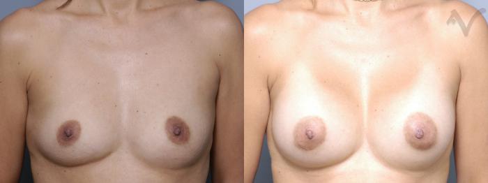 Before & After Breast Augmentation Case 153 Front View in Los Angeles, CA