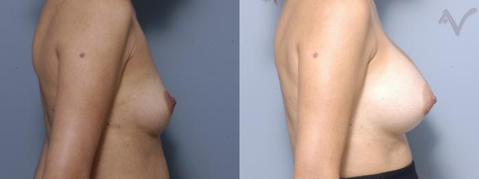 Before & After Breast Augmentation Case 153 Right Side View in Los Angeles, CA