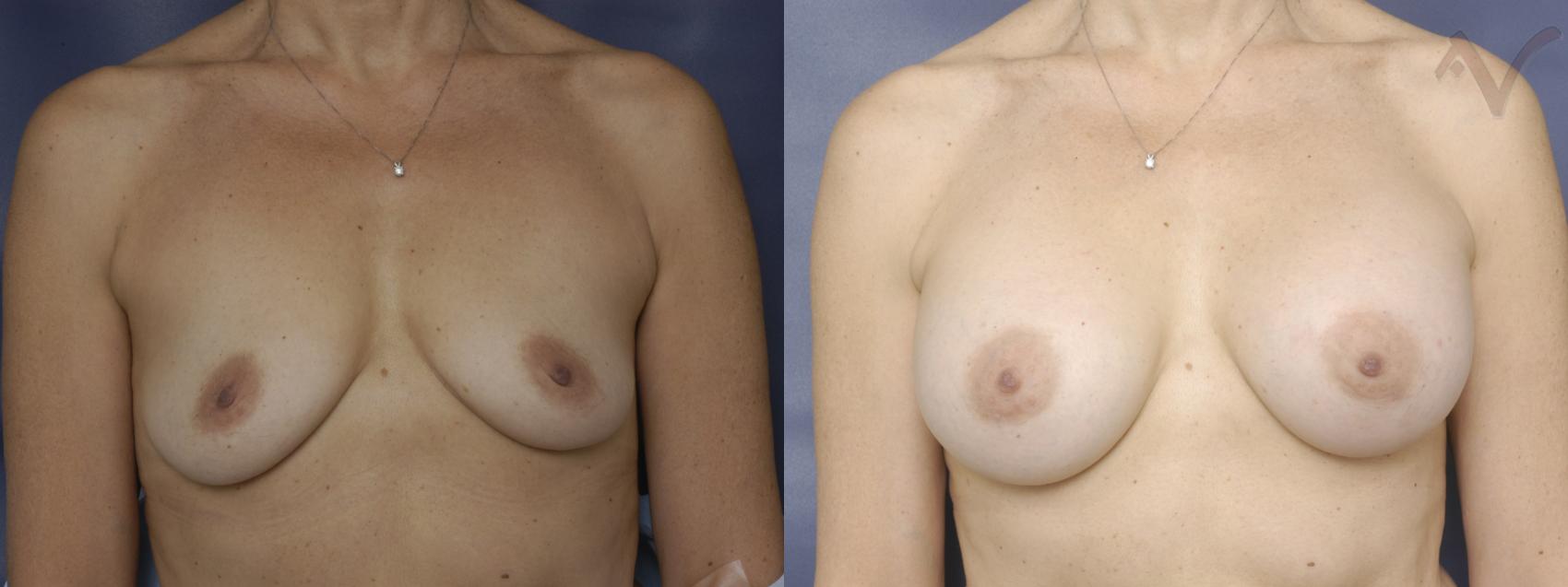 Before & After Breast Augmentation Case 154 Front View in Los Angeles, CA
