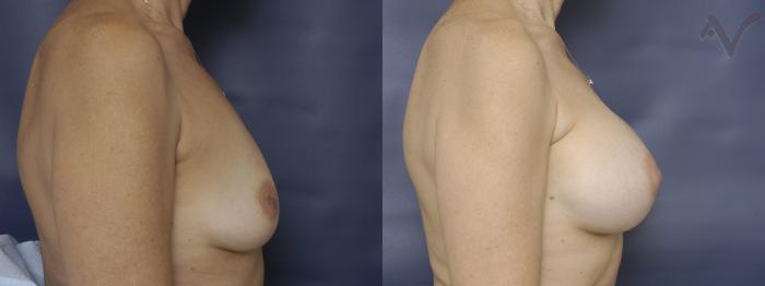Before & After Breast Augmentation Case 154 Right Side View in Los Angeles, CA
