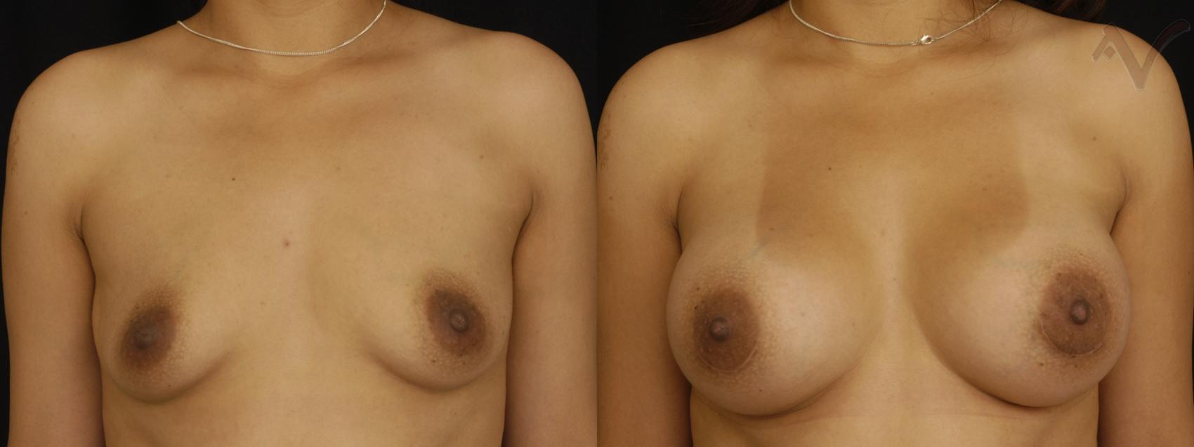 Before & After Breast Augmentation Case 155 Front View in Los Angeles, CA