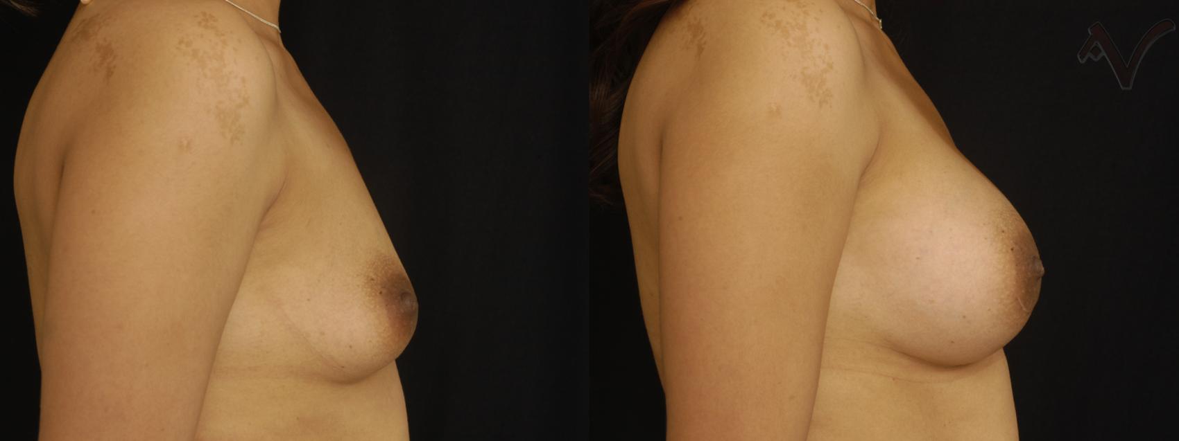 Before & After Breast Augmentation Case 155 Right Side View in Los Angeles, CA