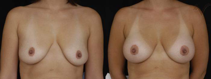 Before & After Breast Augmentation Case 156 Front View in Los Angeles, CA