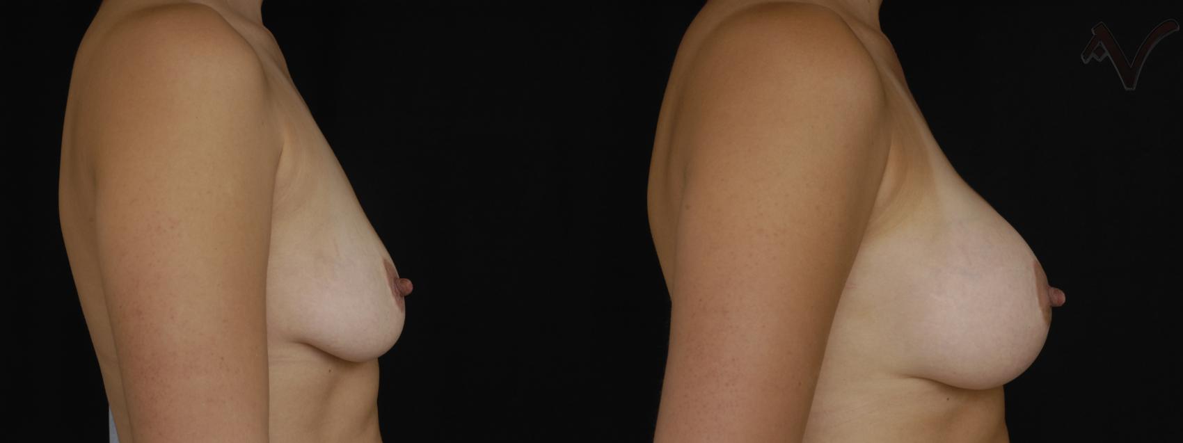 Before & After Breast Augmentation Case 156 Right Side View in Burbank, CA