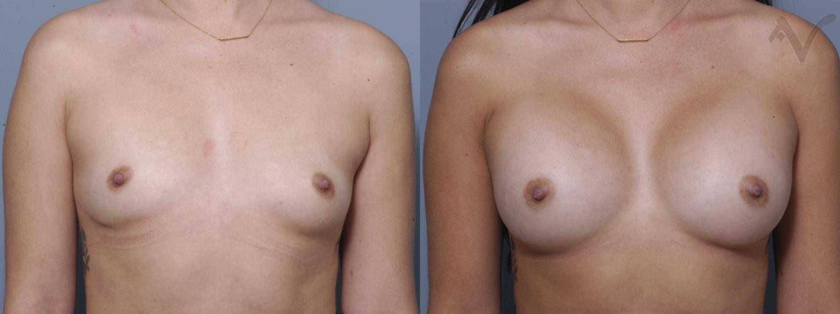 Before & After Breast Augmentation Case 157 Front View in Los Angeles, CA