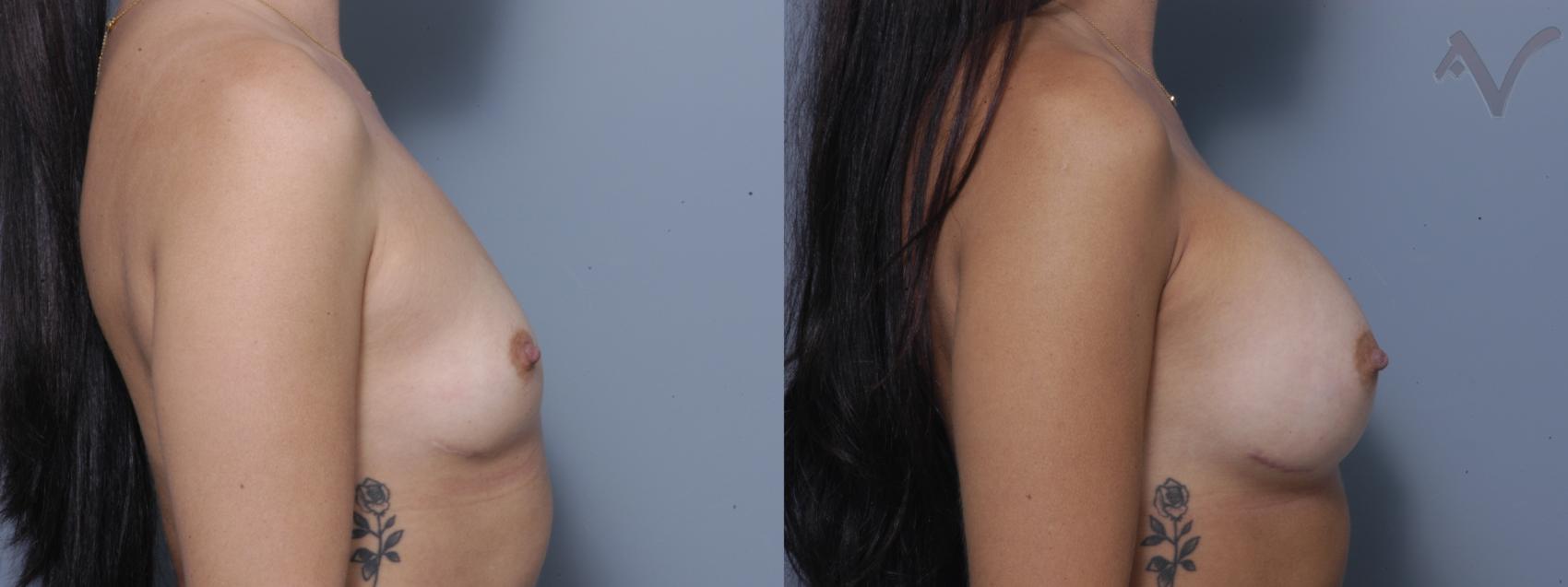 Before & After Breast Augmentation Case 157 Right Side View in Burbank, CA
