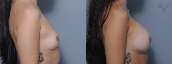 Before & After Breast Augmentation Case 157 Right Side View in Los Angeles, CA