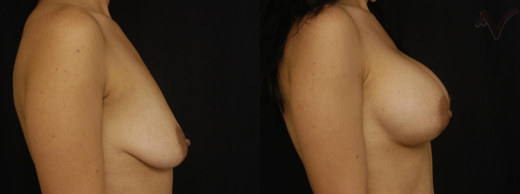 Before & After Breast Augmentation Case 158 Right Side View in Los Angeles, CA