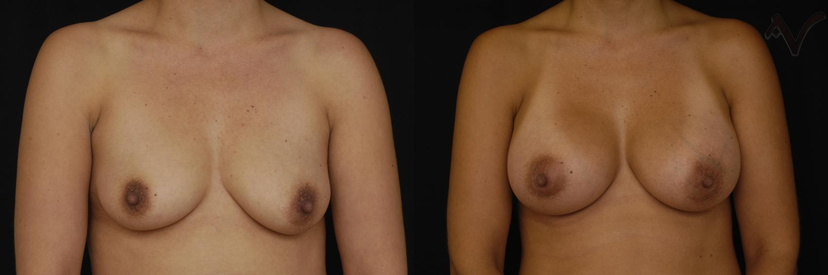 Before & After Breast Augmentation Case 159 Front View in Burbank, CA