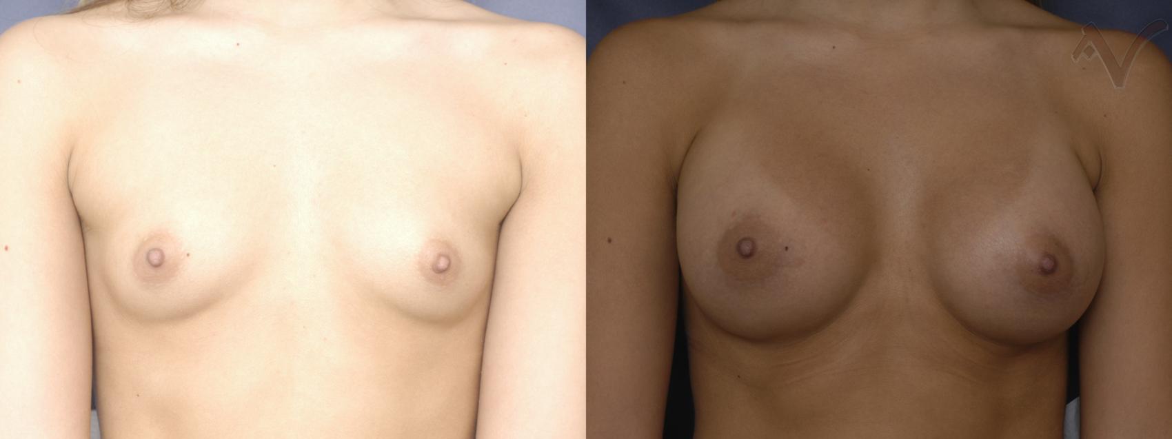 Before & After Breast Augmentation Case 160 Front View in Burbank, CA