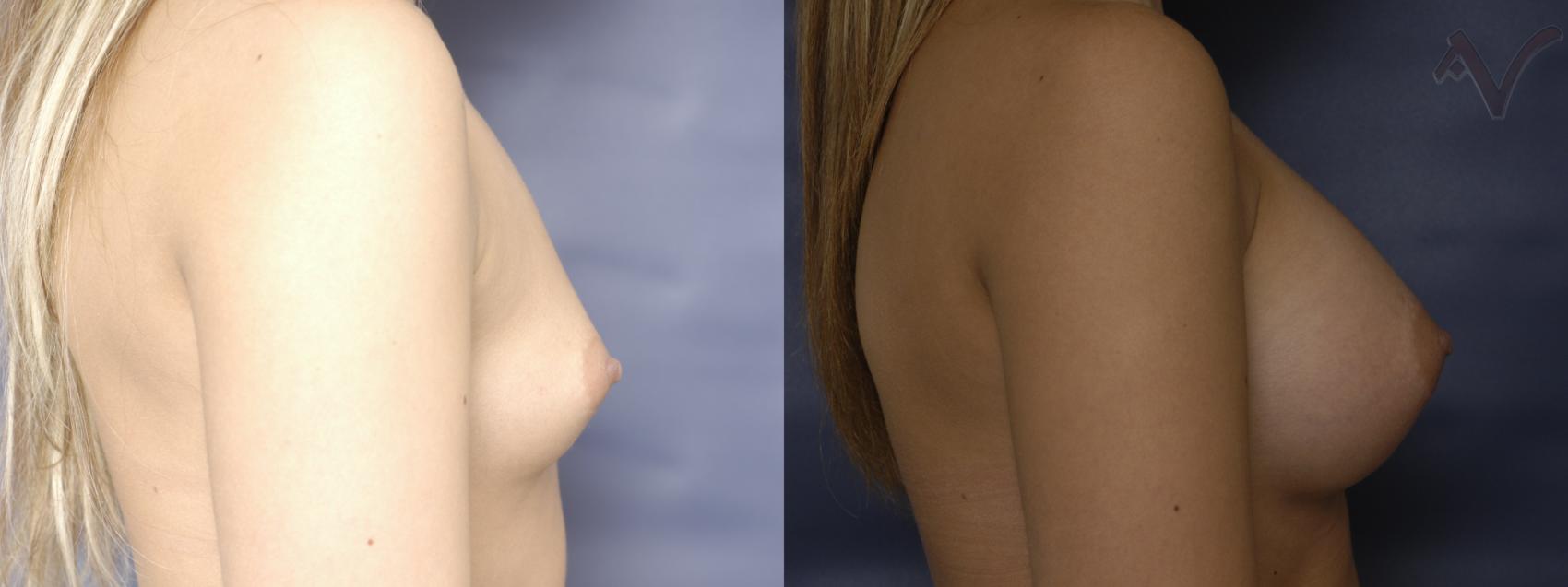 Before & After Breast Augmentation Case 160 Right Side View in Burbank, CA
