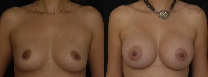 Before & After Breast Augmentation Case 161 Front View in Los Angeles, CA