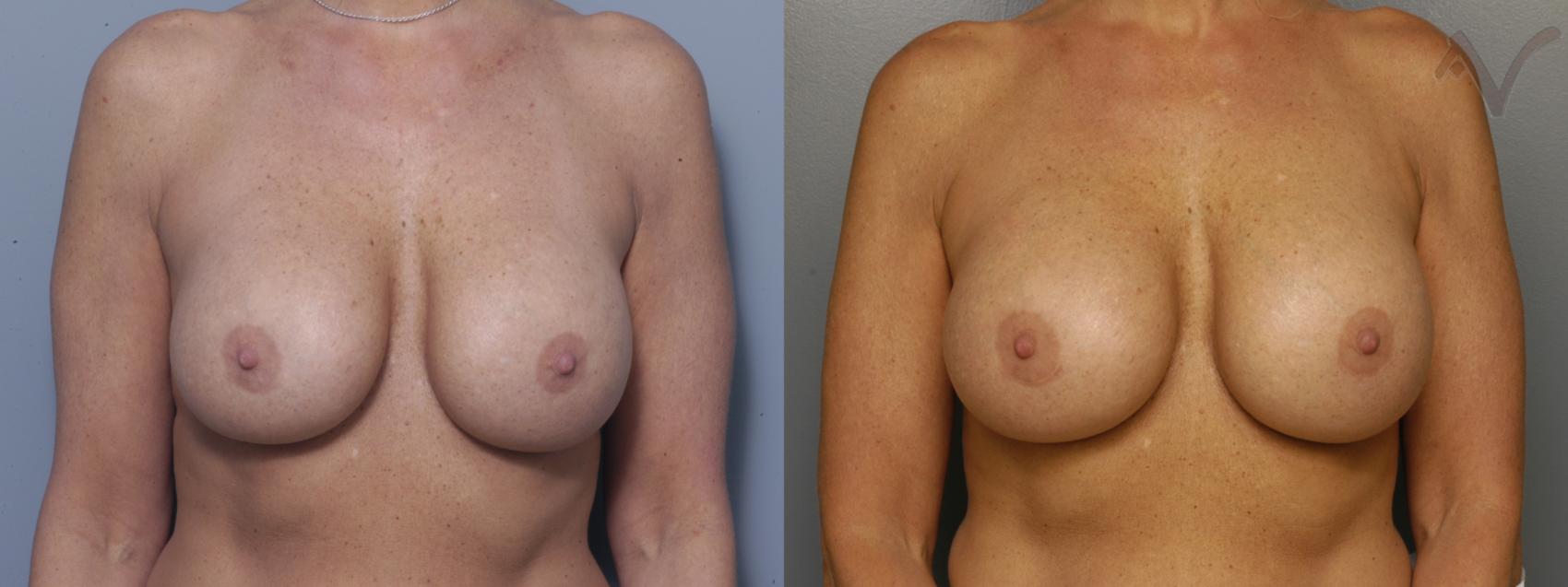 Before & After Breast Augmentation Case 162 Front View in Los Angeles, CA