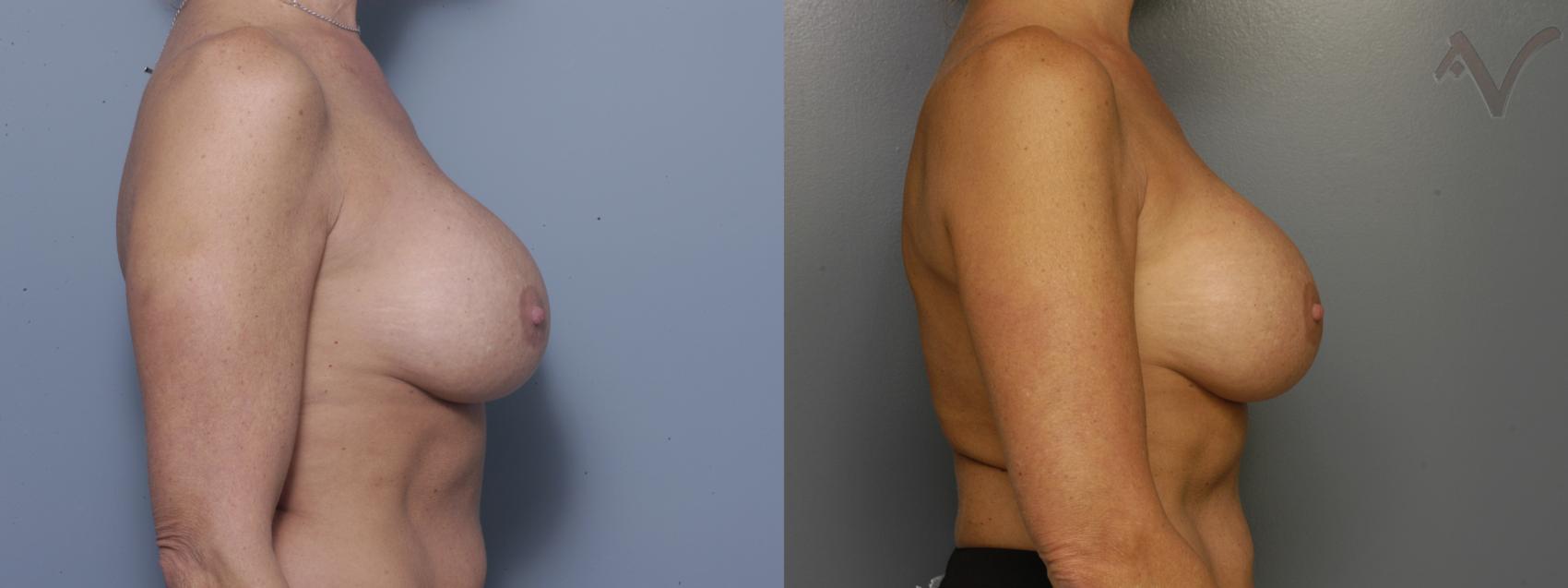 Before & After Breast Augmentation Case 162 Right Side View in Los Angeles, CA