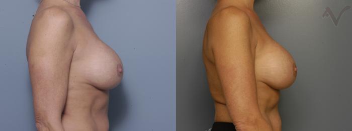 Before & After Breast Augmentation Case 162 Right Side View in Los Angeles, CA