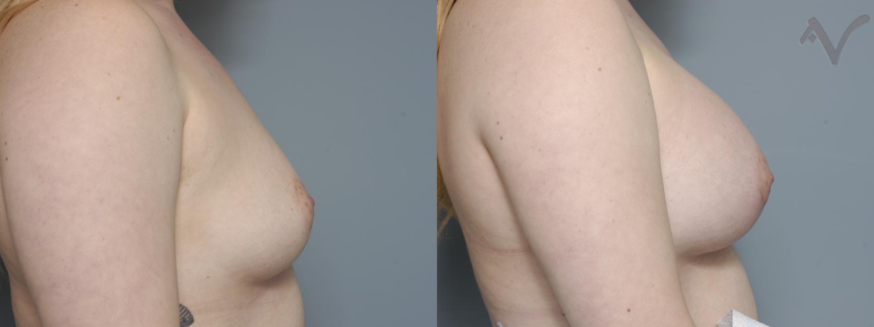 Before & After Breast Augmentation Case 163 Right Side View in Los Angeles, CA