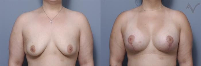 Before & After Breast Augmentation Case 164 Front View in Los Angeles, CA