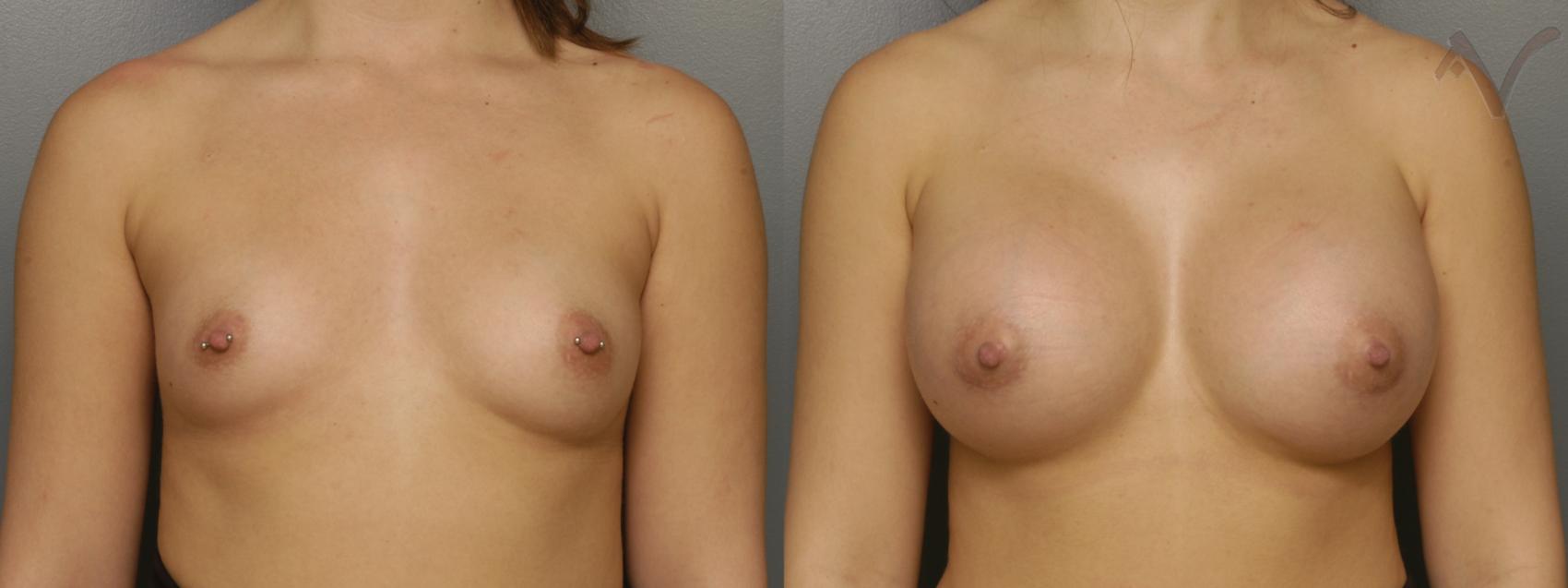 Before & After Breast Augmentation Case 336 Front View in Los Angeles, CA