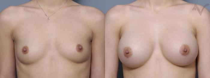 Before & After Breast Augmentation Case 337 Front View in Los Angeles, CA