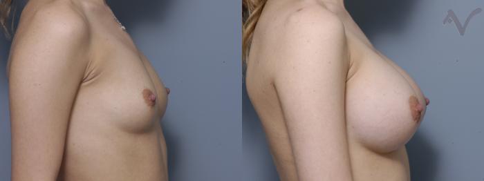 Before & After Breast Augmentation Case 337 Right Side View in Los Angeles, CA