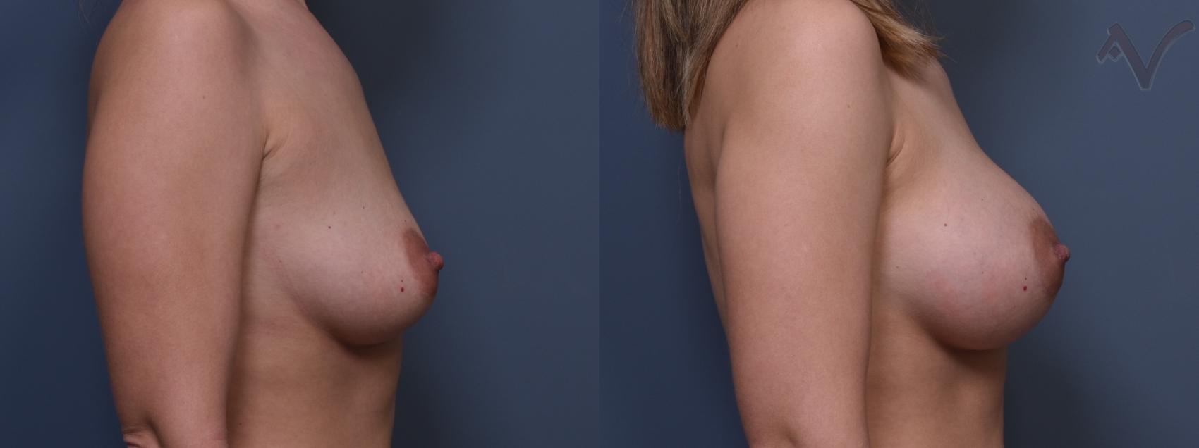 Before & After Breast Augmentation Case 380 Right Side View in Los Angeles, CA