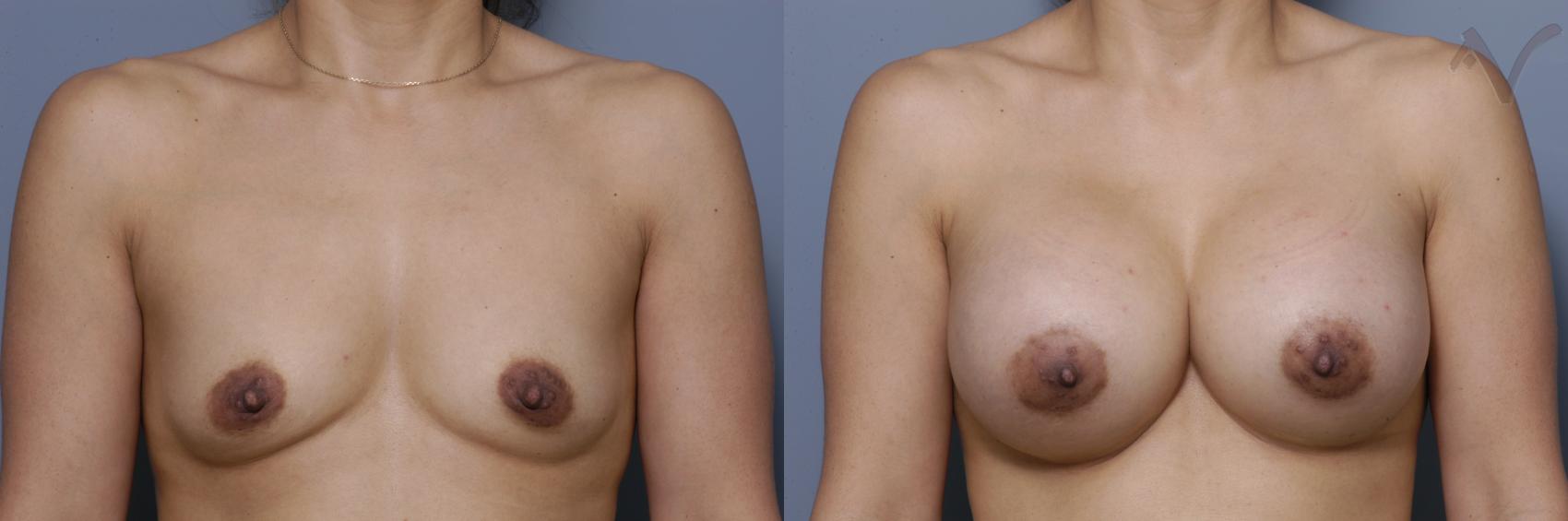 Before & After Breast Augmentation Case 450 Front View in Los Angeles, CA