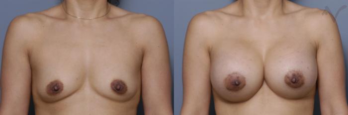 Before & After Breast Augmentation Case 450 Front View in Los Angeles, CA