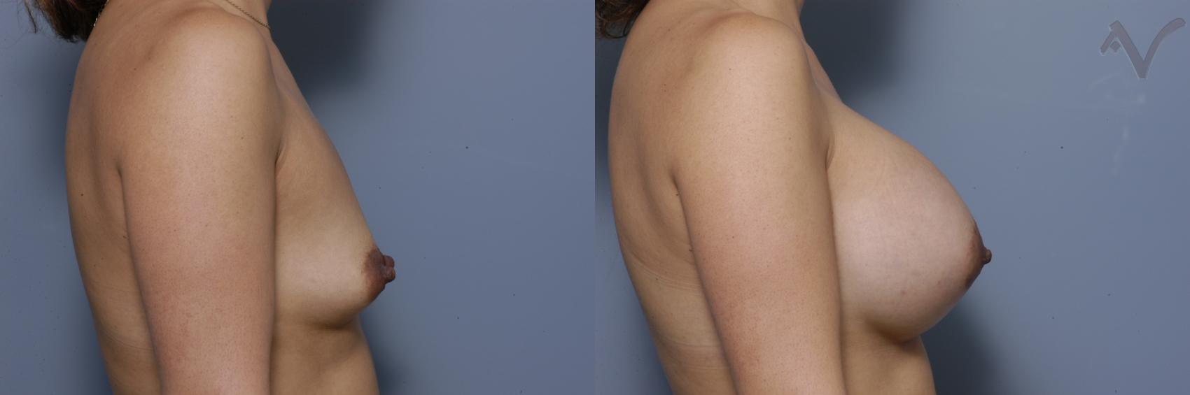 Before & After Breast Augmentation Case 450 Right Side View in Los Angeles, CA
