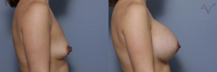 Before & After Breast Augmentation Case 450 Right Side View in Los Angeles, CA