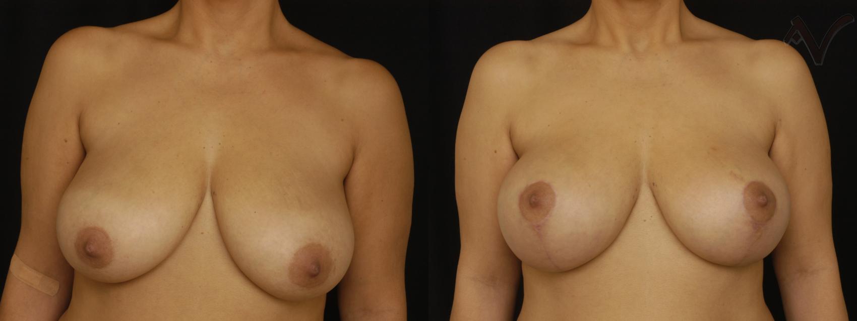 Before & After Breast Augmentation with Lift Case 112 Front View in Burbank, CA