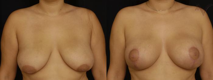 Before & After Breast Augmentation with Lift Case 113 Front View in Los Angeles, CA