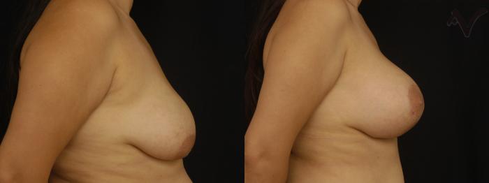 Before & After Breast Augmentation with Lift Case 113 Right Side View in Los Angeles, CA