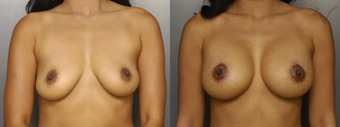 Before & After Breast Augmentation with Lift Case 114 Front View in Los Angeles, CA